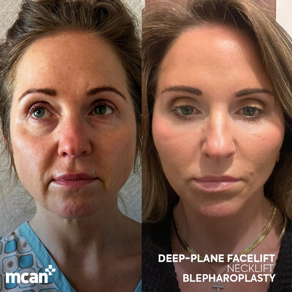 Facelift Before After 7 min