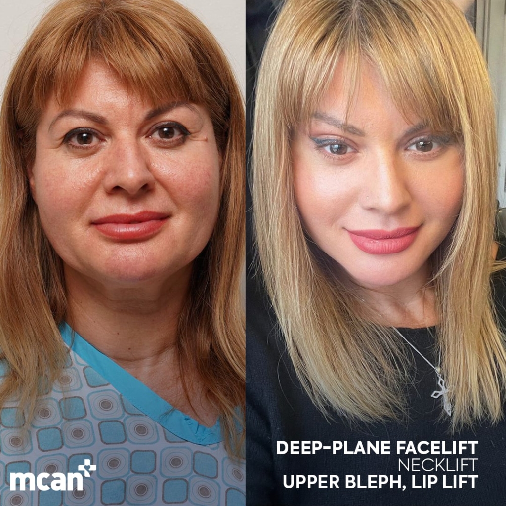 Facelift Before After 8 min