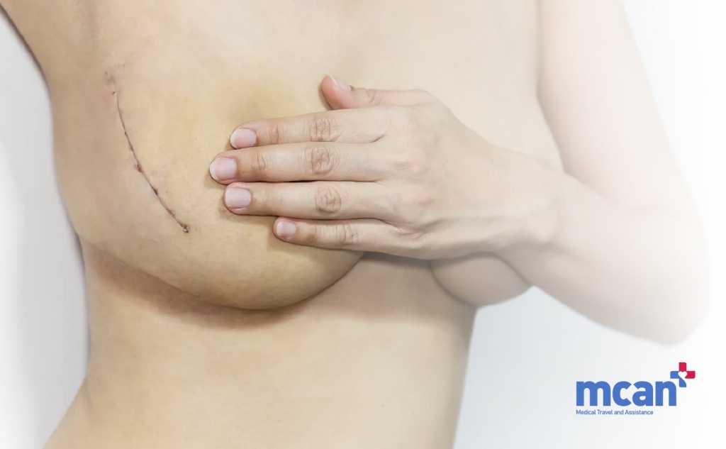 How Visible Are Breast Lift Scars min 1