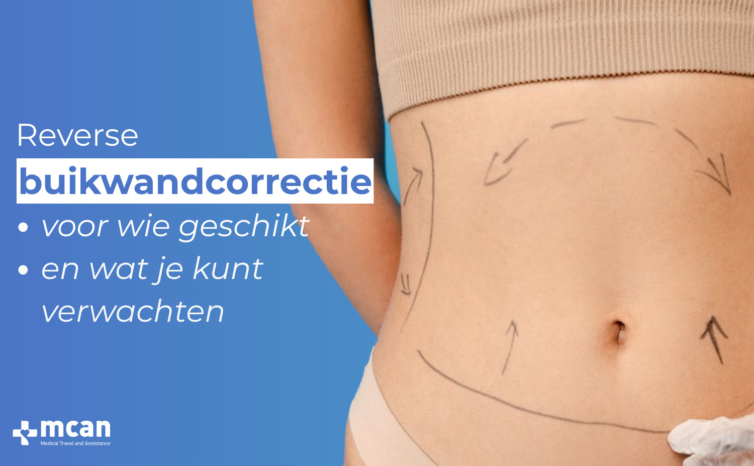 Reverse buikwandcorrectie Blog Cover 3