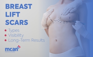Breast Lift Scars: Types, Visibility, and Long-Term Results 4 en Breast Lift Scars min en Breast Lift Scars min