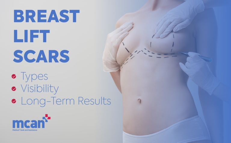 Breast Lift Scars: Types, Visibility, and Long-Term Results 12 en Breast Lift Scars min en Breast Lift Scars min