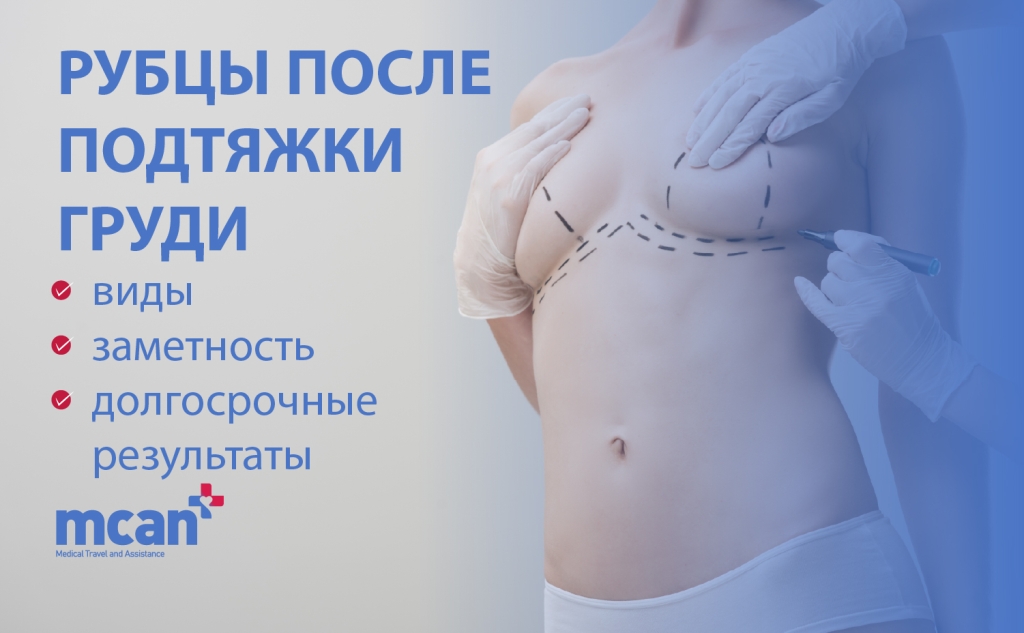 ru Breast Lift Scars