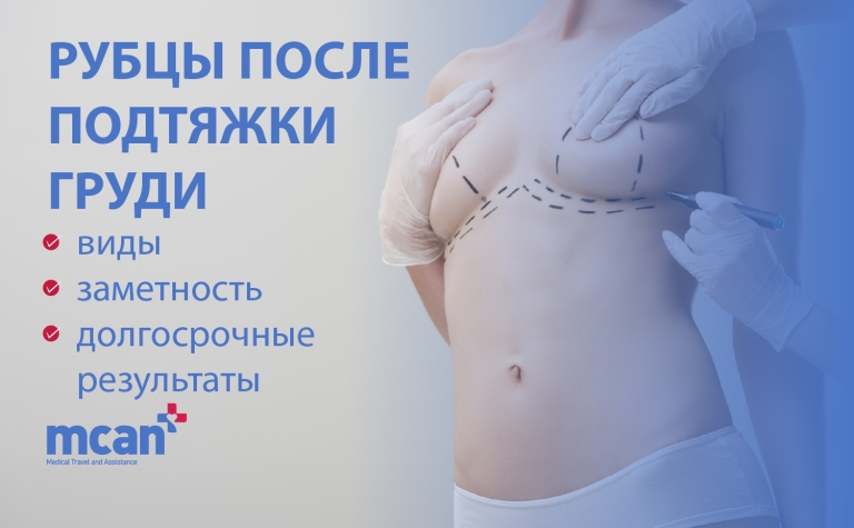 Рубцы после подтяжки груди: виды, заметность и долгосрочные результаты 10 ru Breast Lift Scars ru Breast Lift Scars
