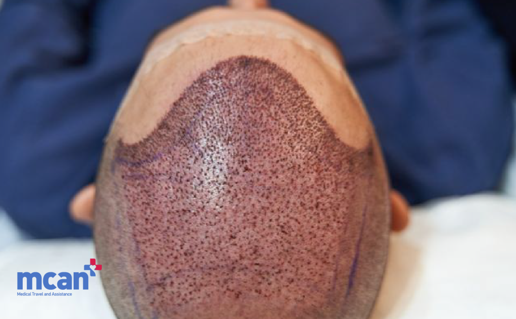 Hair Care After Hair Transplant: Products That Support Recovery and Growth 3 Common Product Related Mistakes After Hair Transplant Common Product Related Mistakes After Hair Transplant