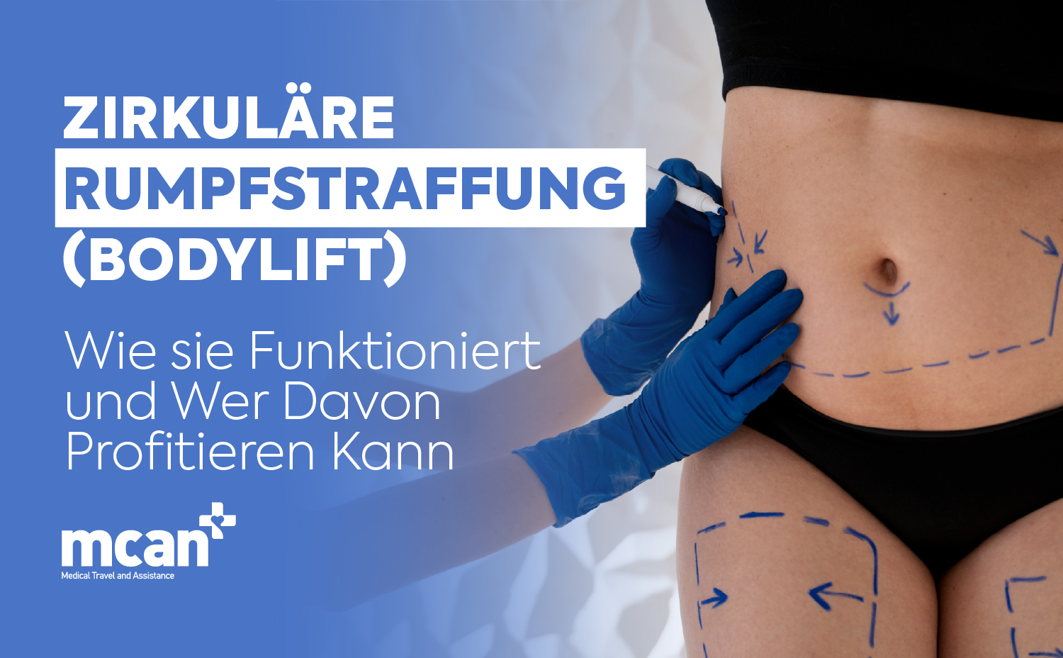 DE Circumferential Tummy Tuck