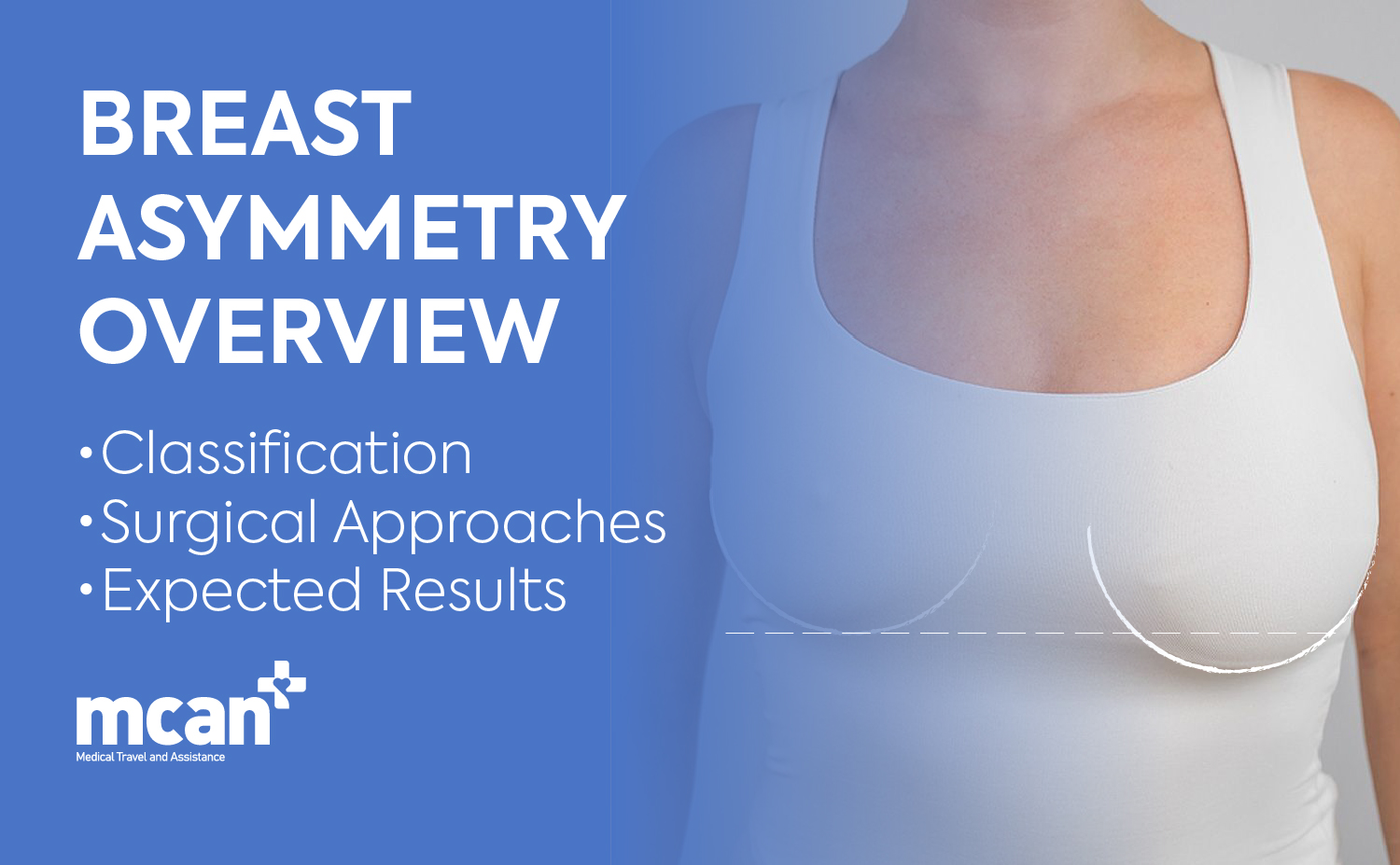 Breast Asymmetry Overview: Classification, Surgical Approaches, and Expected Results 8 EN Breast Asymmetry Overview EN Breast Asymmetry Overview