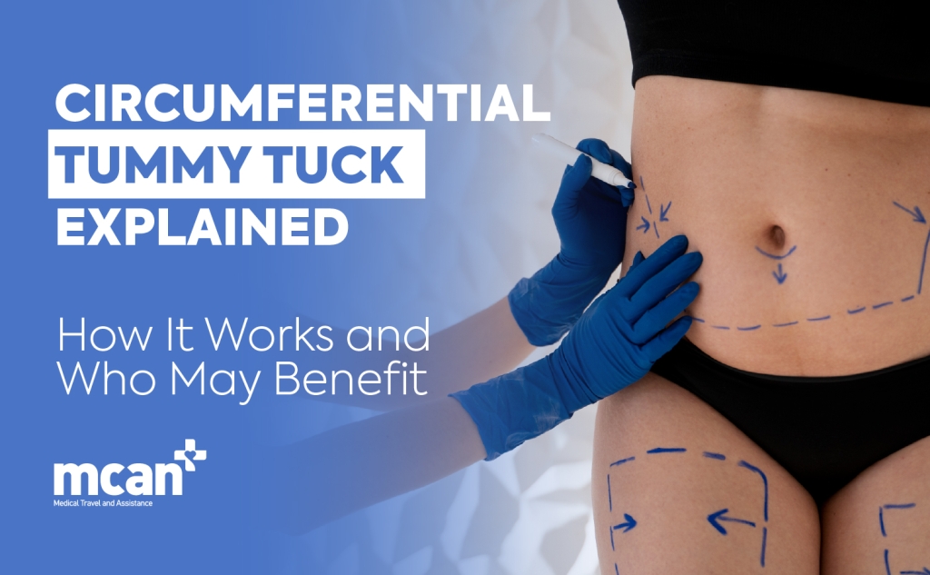 EN Circumferential Tummy Tuck Explained