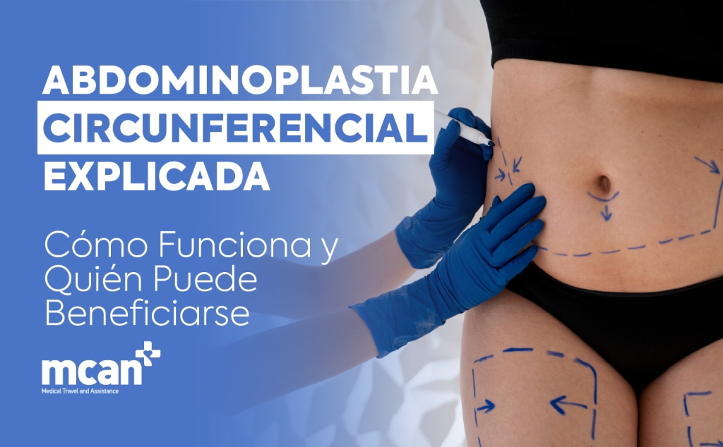 ES Circumferential Tummy Tuck Explained