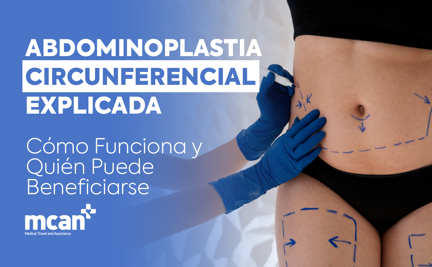 ES Circumferential Tummy Tuck