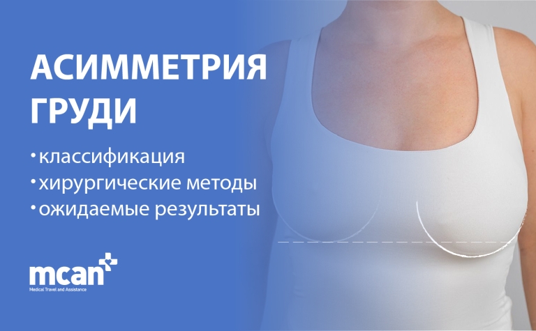 Асимметрия груди: классификация, хирургические методы и ожидаемые результаты 2 RU Breast Asymmetry Overview RU Breast Asymmetry Overview