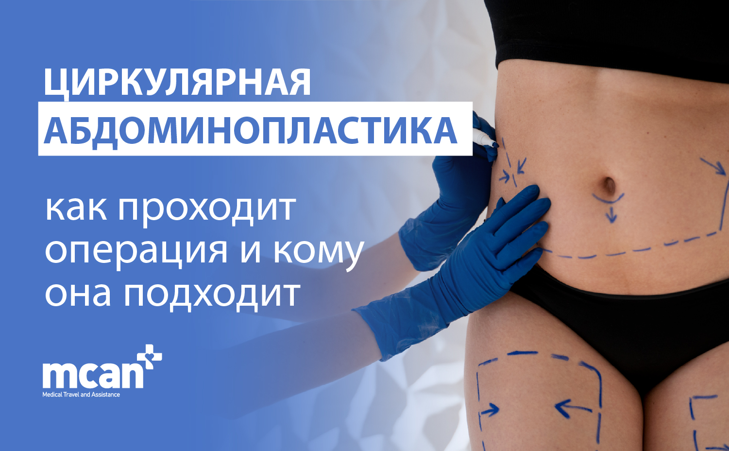 RU Circumferential Tummy Tuck