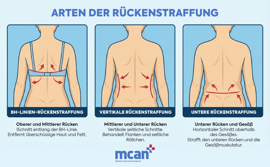 de TYPES OF BACK LIFT SURGERY