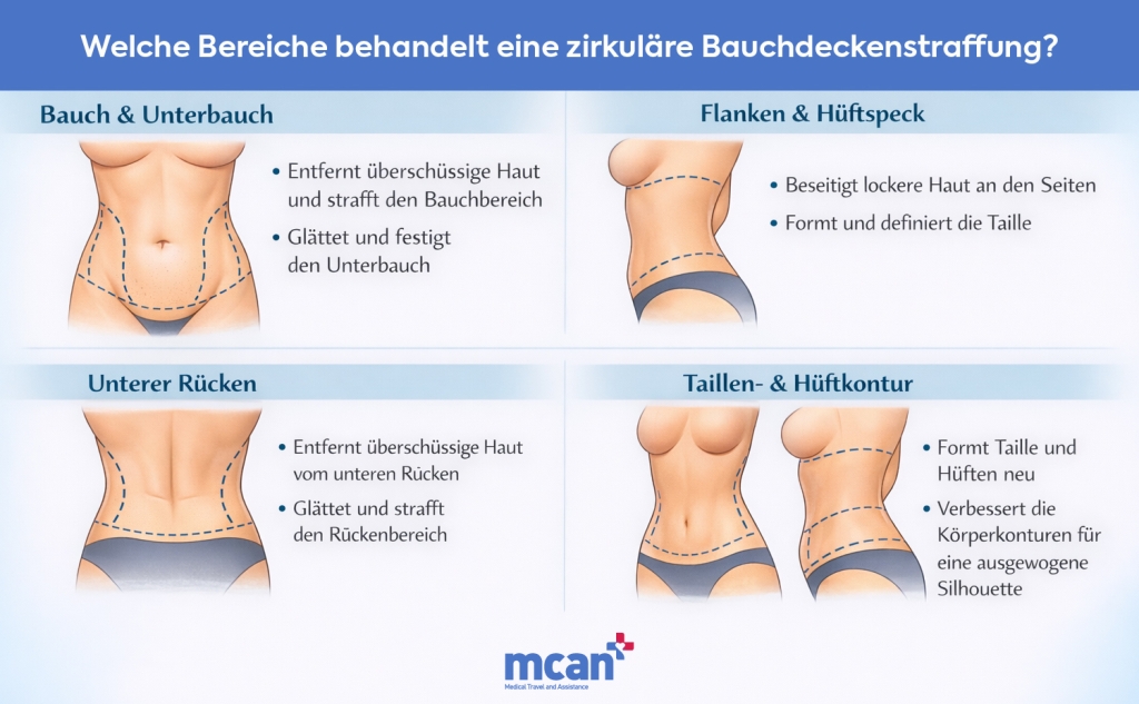 Zirkuläre Rumpfstraffung (Bodylift): Wie sie funktioniert und wer davon profitieren kann 2 de What Areas Does a Circumferential Tummy Tuck Treat de What Areas Does a Circumferential Tummy Tuck Treat