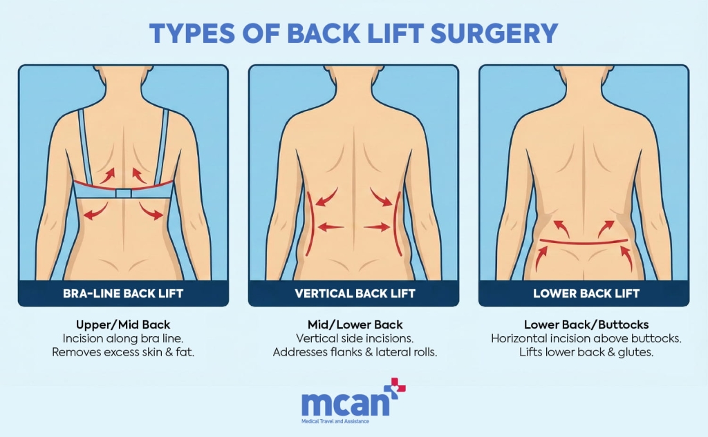 en TYPES OF BACK LIFT SURGERY