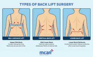 What Is Back Lift Surgery and When Is It Recommended? | MCAN Health Blog