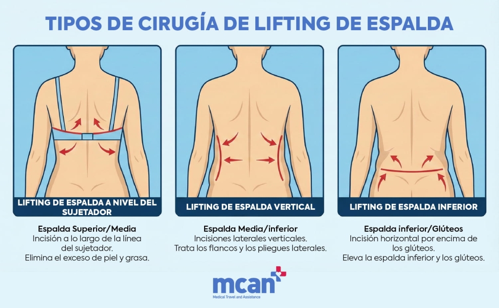 es TYPES OF BACK LIFT SURGERY