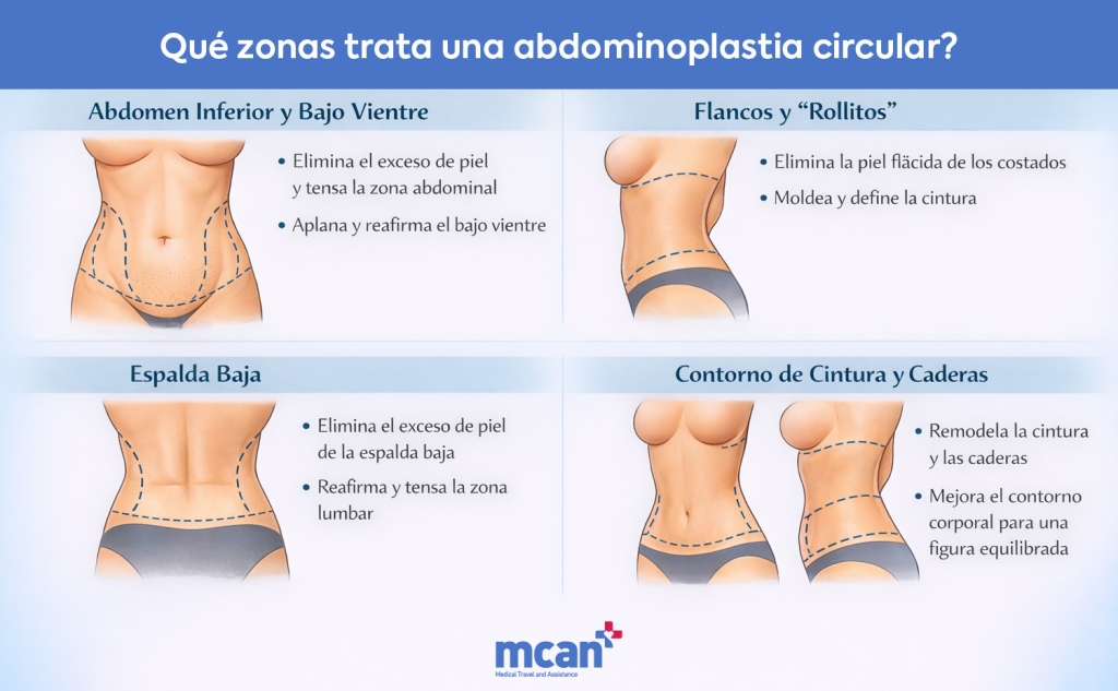 es What Areas Does a Circumferential Tummy Tuck Treat