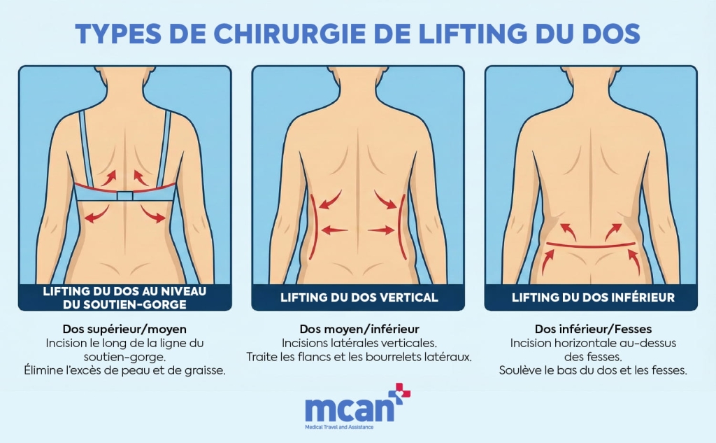 fr TYPES OF BACK LIFT SURGERY