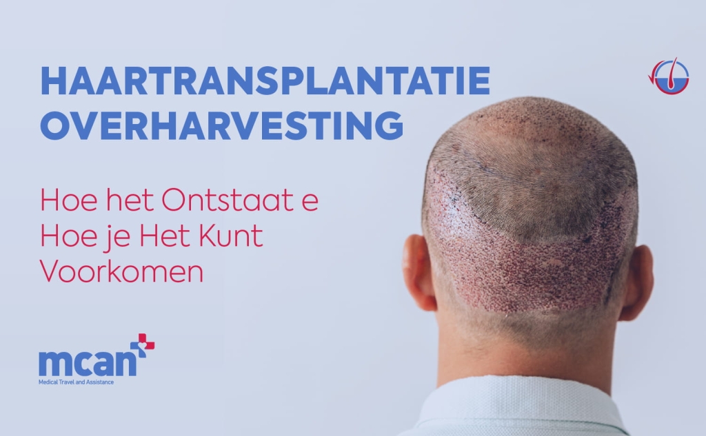 Haartransplantatie overharvesting: hoe het ontstaat en hoe je het kunt voorkomen 1 nl nl