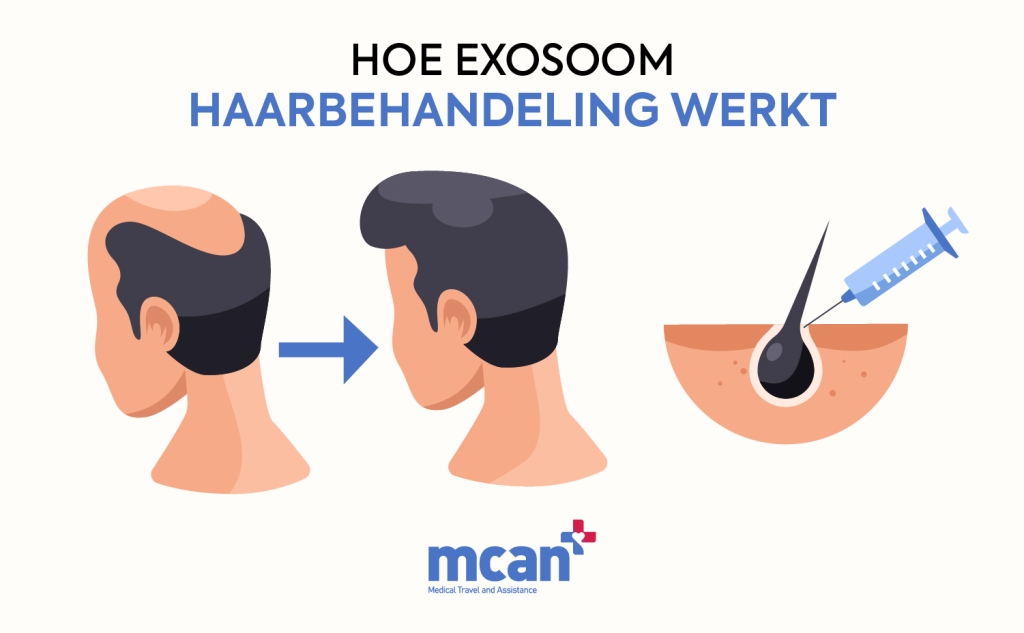 nl How Exosome Hair Treatment Works