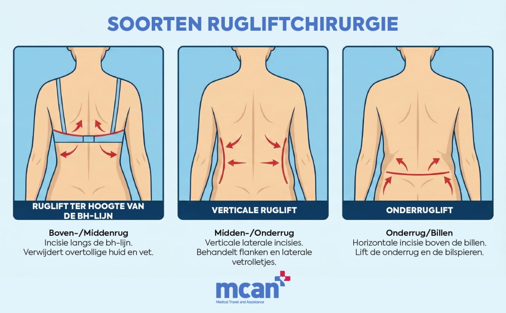 Wat is een ruglift en wanneer wordt deze aanbevolen? 2 nl TYPES OF BACK LIFT SURGERY nl TYPES OF BACK LIFT SURGERY