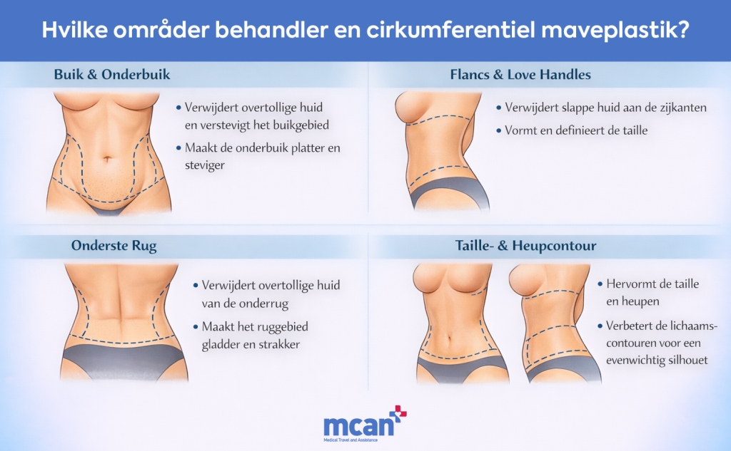 Circumferente buikwandcorrectie uitgelegd: hoe het werkt en wie ervan kan profiteren 2 nl What Areas Does a Circumferential Tummy Tuck Treat nl What Areas Does a Circumferential Tummy Tuck Treat