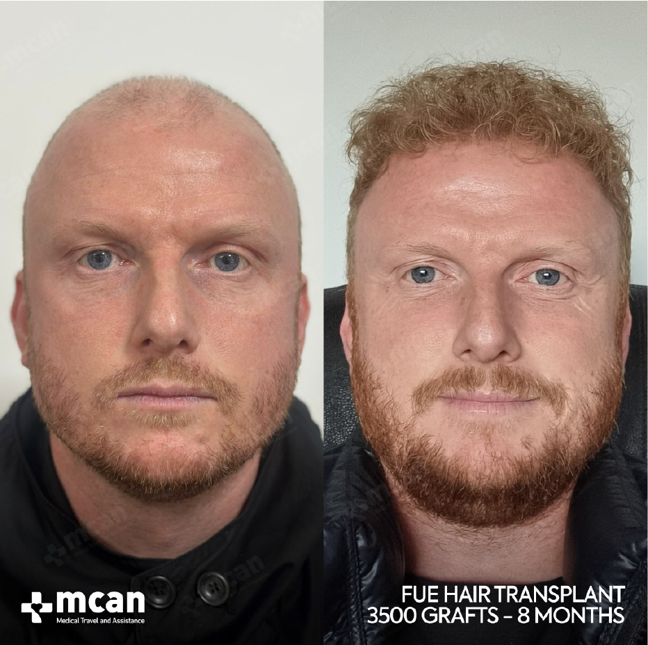 Hair Transplant Pain Explained: Honest Answers for Patients 6 Before After Before After