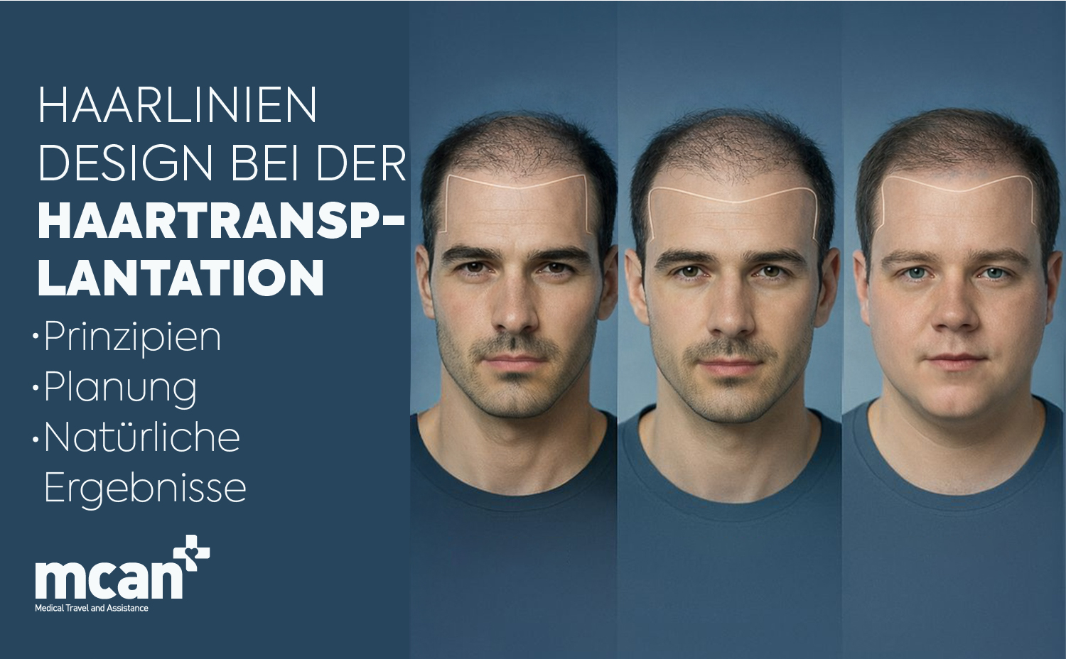 Haarlinien Design bei der Haartransplantation: Prinzipien, Planung und natürliche Ergebnisse