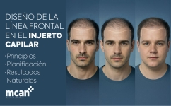 Diseño de la línea frontal en el injerto capilar: principios, planificación y resultados naturales