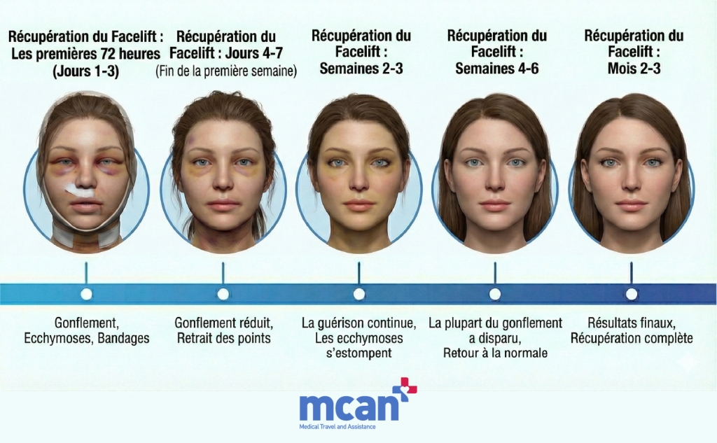 Récupération après un lifting du visage : à quoi s’attendre des jours aux mois 2 FR Facelift Recovery 72 HOURS Récupération lifting du visage : Les 72 premières heures (jours 1‑3)