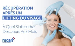 FR Facelift Recovery Timeline