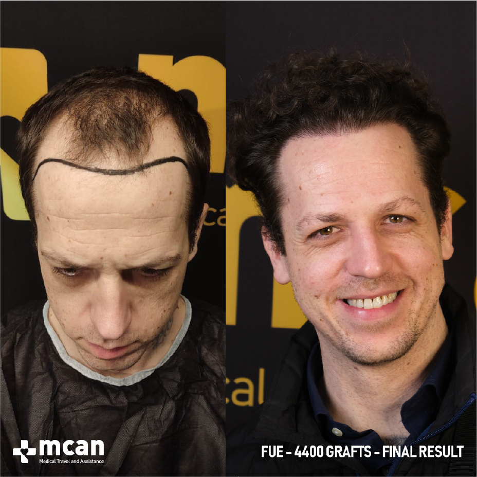 Keloid Risk Management for Your Hair Transplant in Turkey with MCAN Health