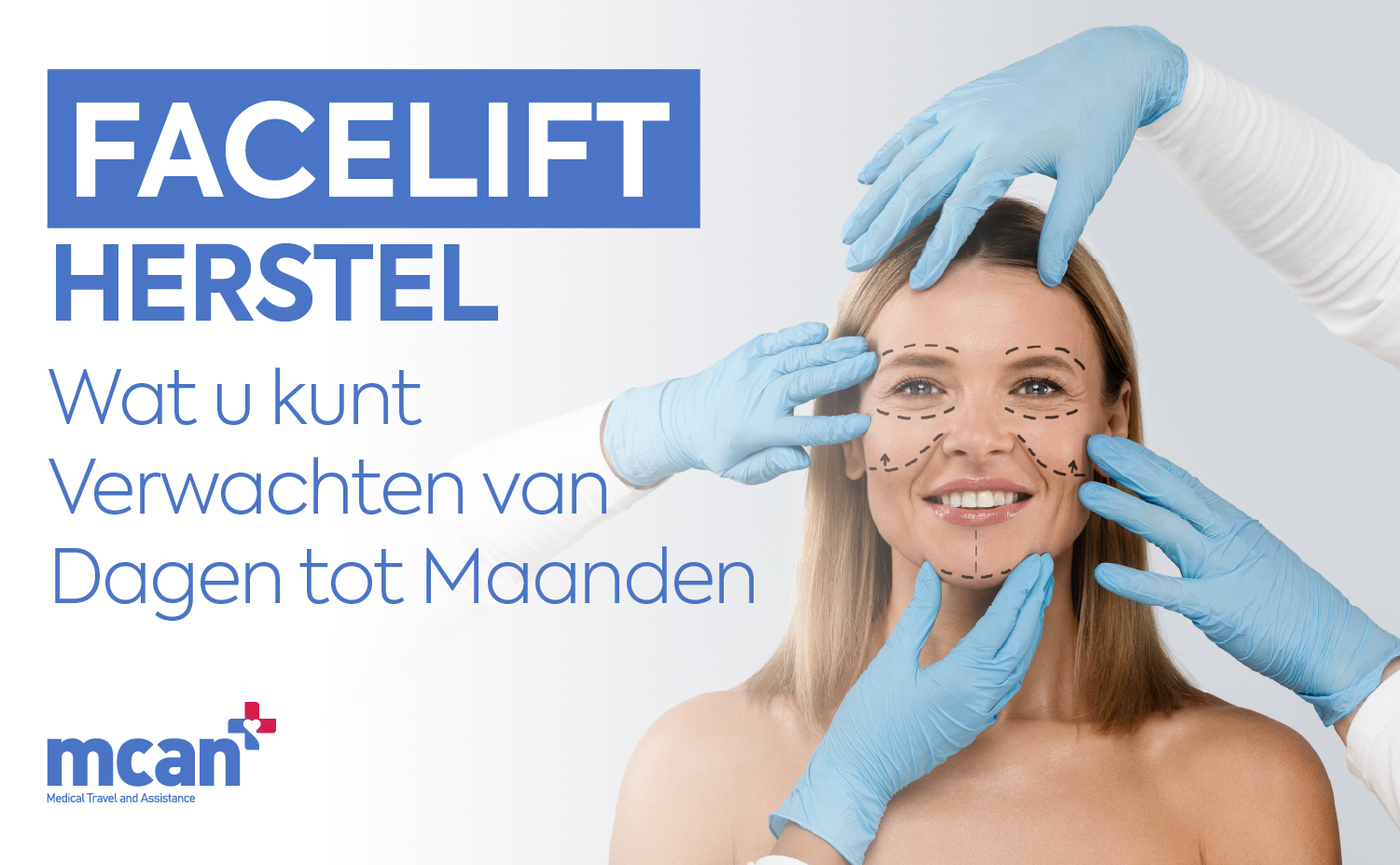 Facelift herstel: wat u kunt verwachten van dagen tot maanden
