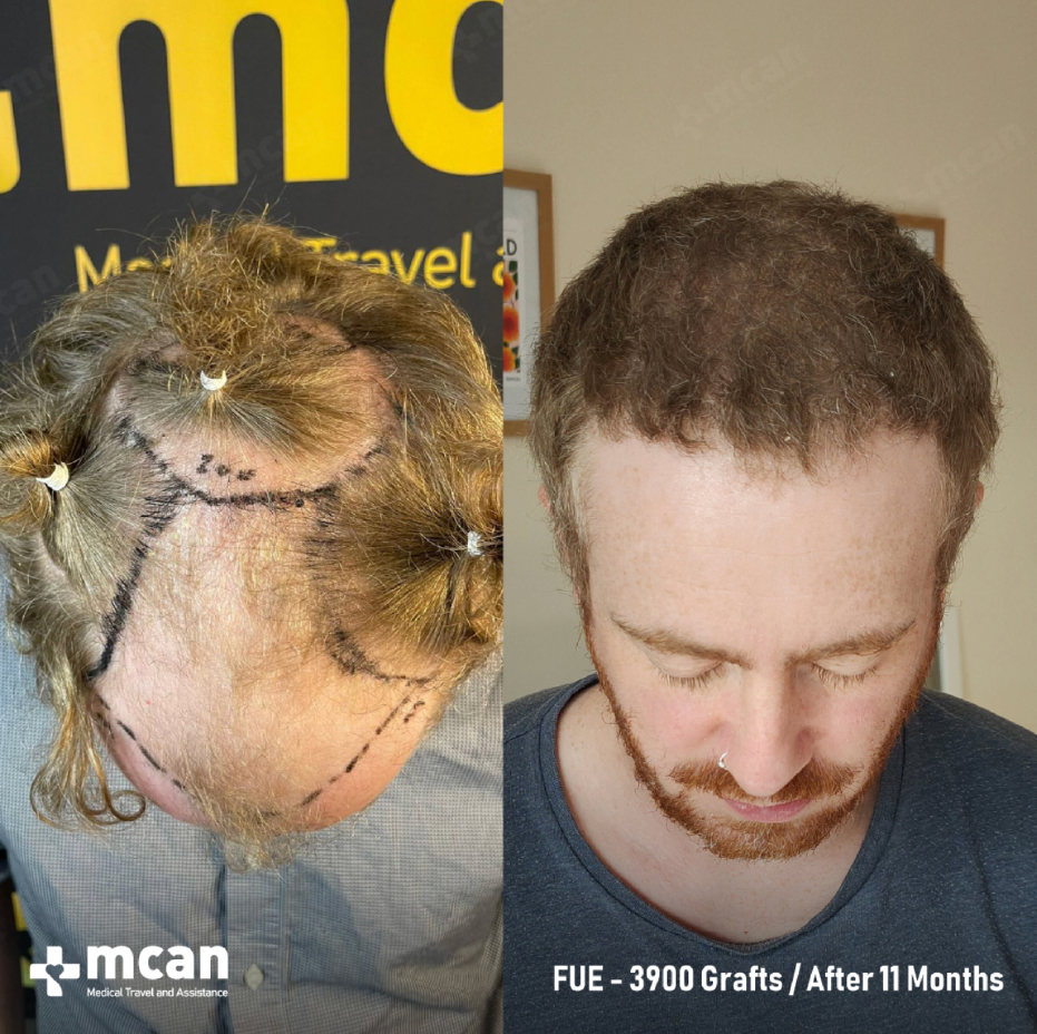 Perfect Hairline Design in Your Hair Transplant in Turkey With MCAN Health