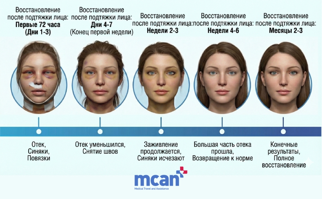 Восстановление после подтяжки лица: чего ожидать от первых дней до месяцев 2 RU Facelift Recovery 72 HOURS Восстановление после подтяжки лица: первые 72 часа (дни 1–3)