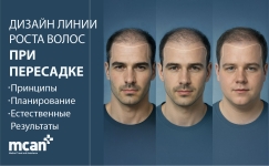 Дизайн линии роста волос при пересадке: принципы, планирование и естественные результаты