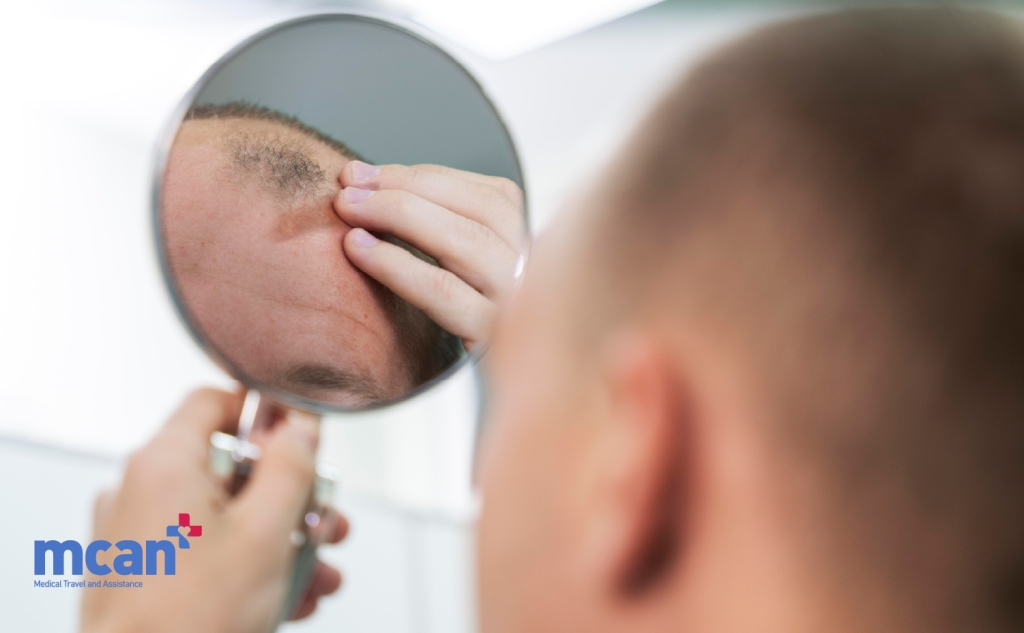 When a Hair Transplant Is Not Recommended