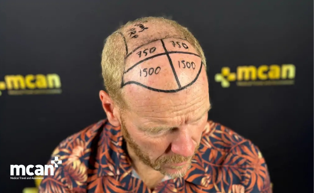 Why Hairline Design Matters More Than Graft Count