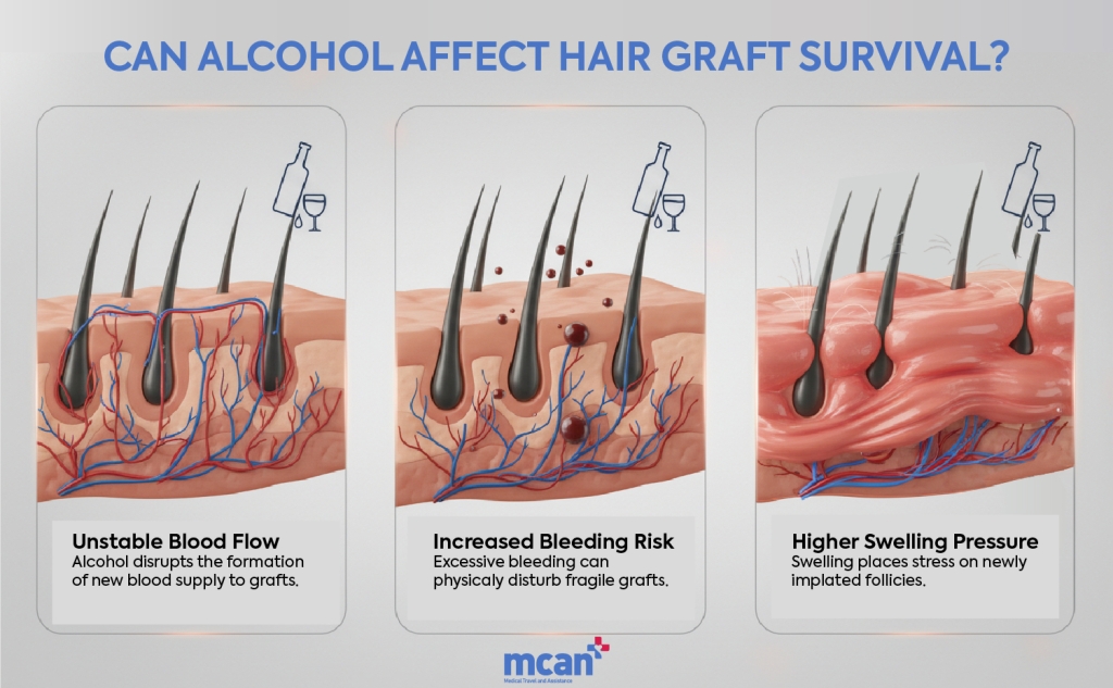 en Can Alcohol Affect Hair Graft Survival