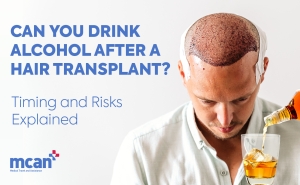 en Can You Drink Alcohol After a Hair Transplant