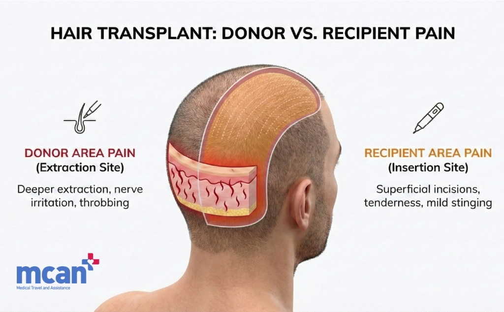 Hair Transplant Pain Explained: Honest Answers for Patients 3 en Donor Area Pain vs Recipient Area Pain en Donor Area Pain vs Recipient Area Pain