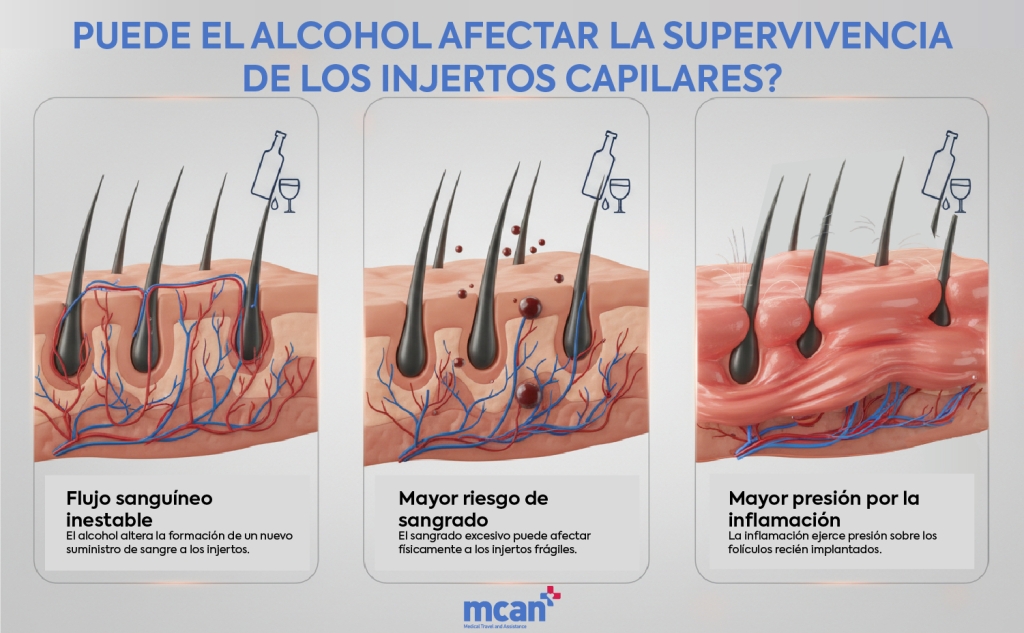 es Can Alcohol Affect Hair Graft Survival