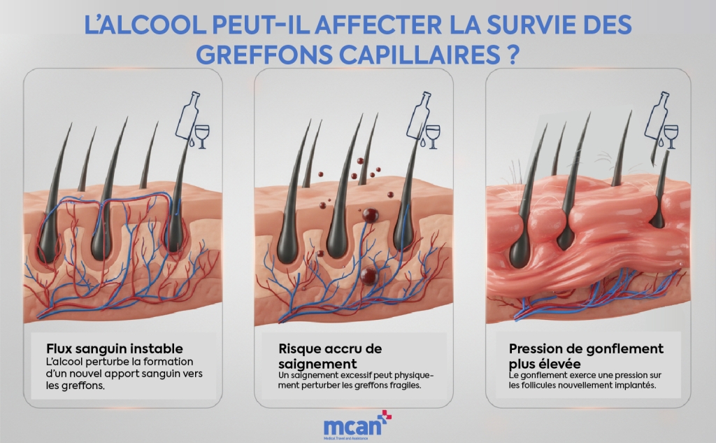 fr Can Alcohol Affect Hair Graft Survival
