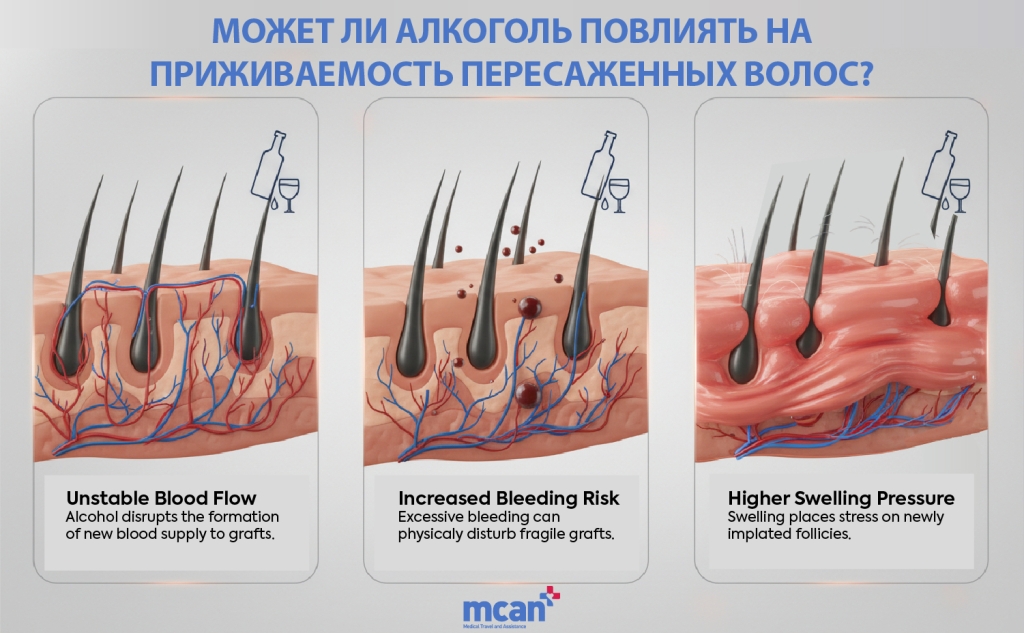 ru Can Alcohol Affect Hair Graft Survival