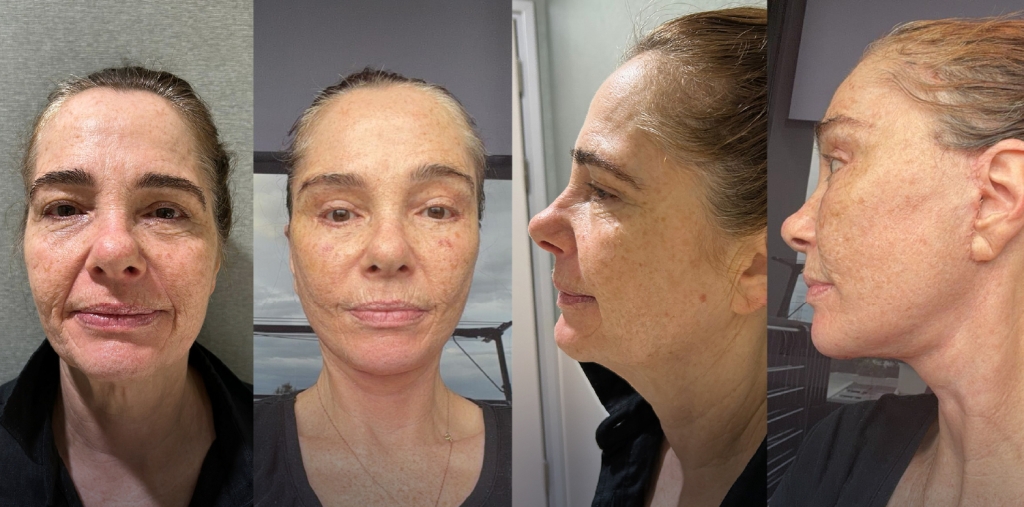 Choosing a Well Planned Facelift in Turkey with MCAN Health