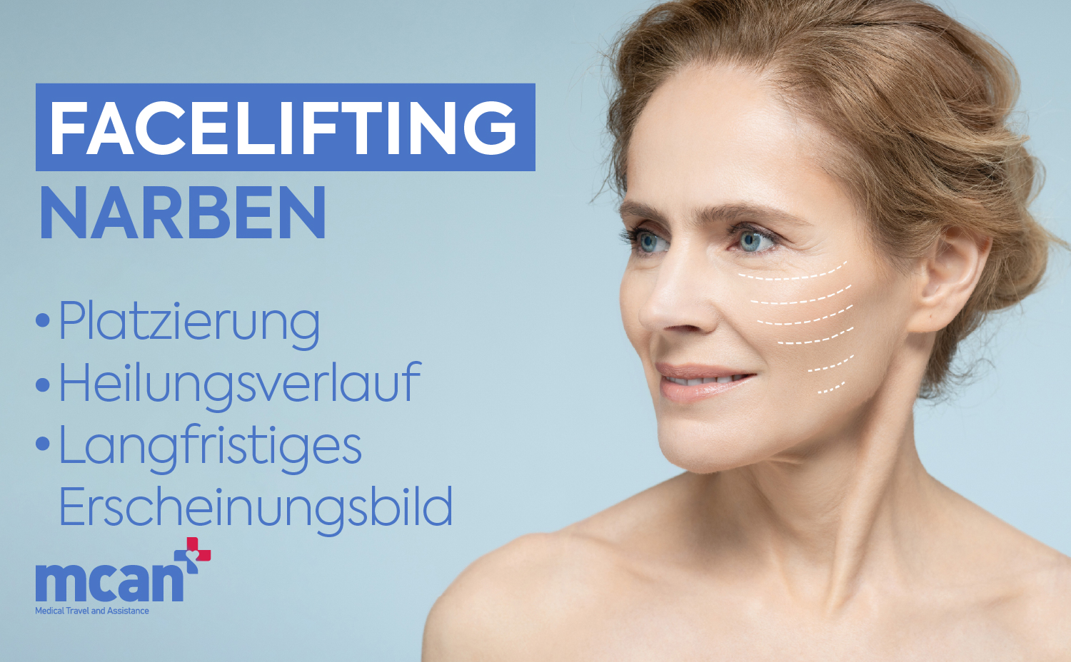Facelifting Narben: Platzierung, Heilungsverlauf und langfristiges Erscheinungsbild