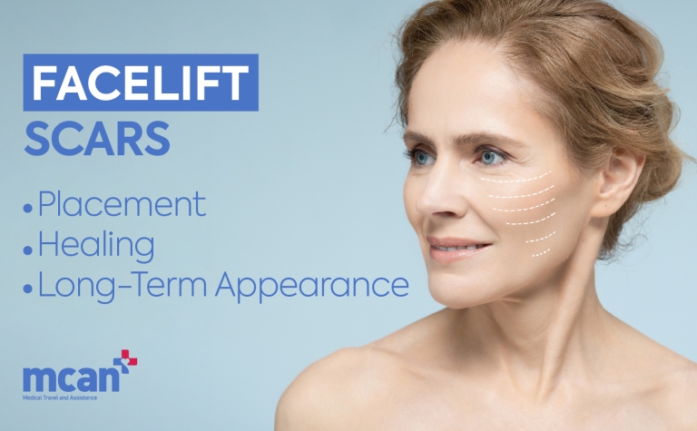Facelift in Turkey 83 EN Facelift SCARS Facelift Scars: Placement, Healing, and Long-Term Appearance