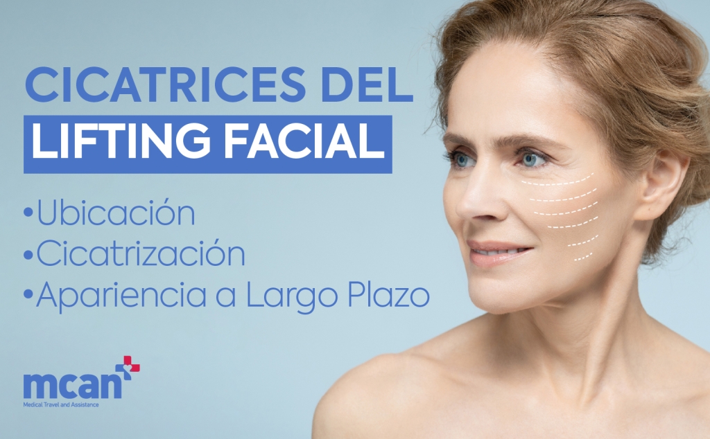 Cicatrices del lifting facial: ubicación, cicatrización y apariencia a largo plazo