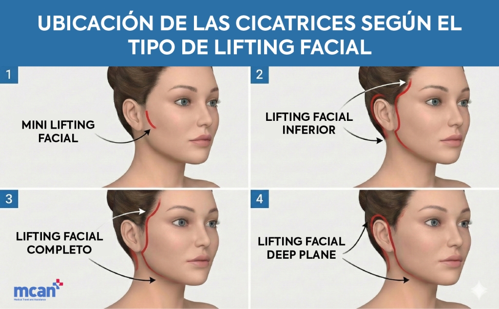 Colocación de cicatrices del Lifting facial según el tipo de Lifting